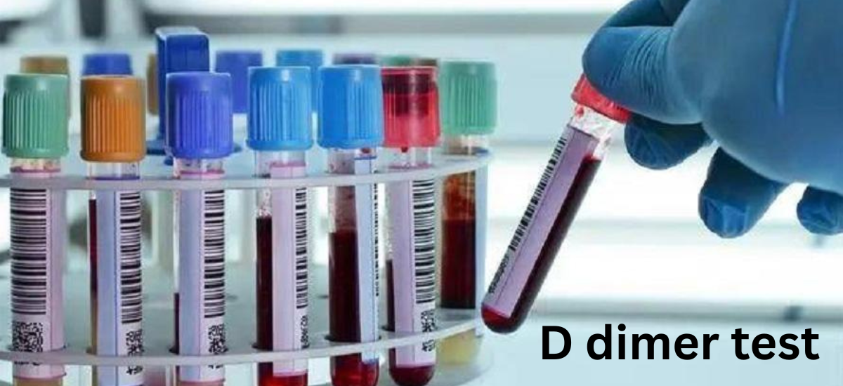 ICD 10 code for D dimer test
