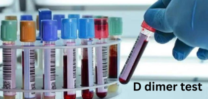 ICD 10 code for D dimer test