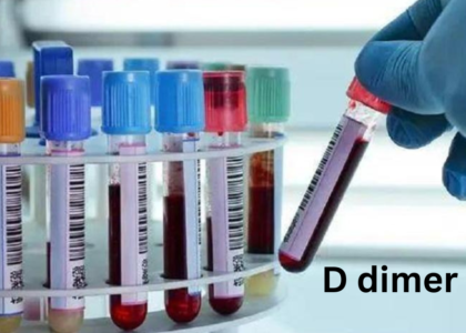 ICD 10 code for D dimer test
