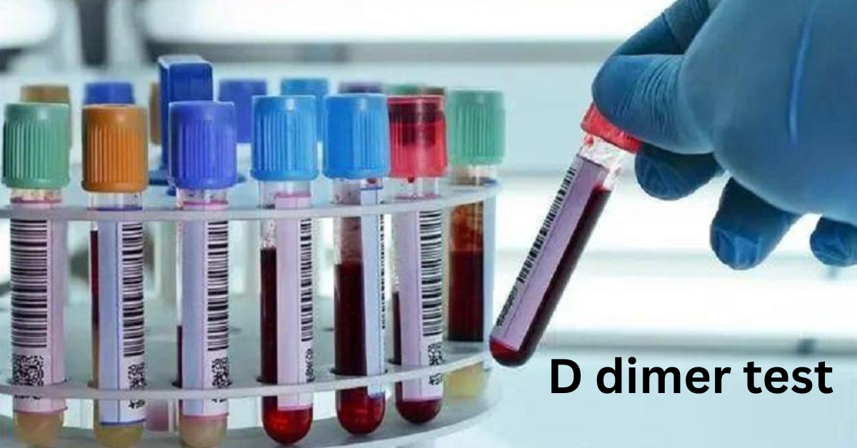 2026 ICD 10 Code for D Dimer Test: Complete Guide for Coders and Clinicians